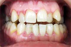 фото зубов до ортодонтического лечения