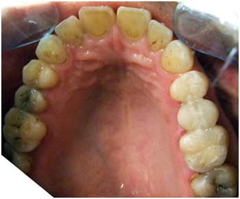 фото зубов после лечения