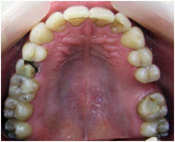 зубы до лечения фото