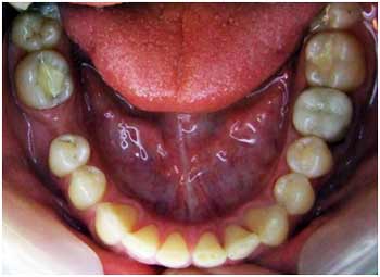 фото зубов после установки пломбы