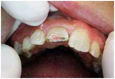 фото лечения переднего зуба